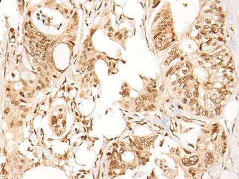 Immunohistochemistry of paraffin-embedded Human colorectal cancer tissue using ARID1B Polyclonal Antibody at dilution of 1:40(×200)