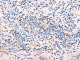 Immunohistochemistry of paraffin-embedded Human cervical cancer tissue using GKAP1 Polyclonal Antibody at dilution of 1:95(×200)