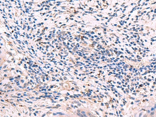Immunohistochemistry of paraffin-embedded Human cervical cancer tissue using GKAP1 Polyclonal Antibody at dilution of 1:95(×200)