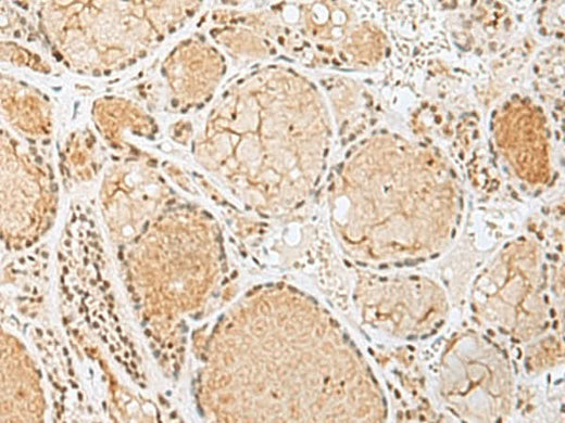 Immunohistochemistry of paraffin-embedded Human thyroid cancer tissue using HIST1H2BK Polyclonal Antibody at dilution of 1:60(×200)