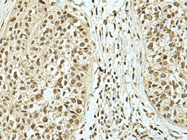 Immunohistochemistry of paraffin-embedded Human esophagus cancer tissue using KHSRP Polyclonal Antibody at dilution of 1:40(×200)