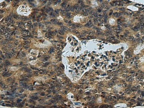 Immunohistochemistry of paraffin-embedded Human colorectal cancer tissue using PLTP Polyclonal Antibody at dilution of 1:60(×200)