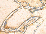 Immunohistochemistry of paraffin-embedded Human thyroid cancer tissue using IGFBPL1 Polyclonal Antibody at dilution of 1:55(×200)