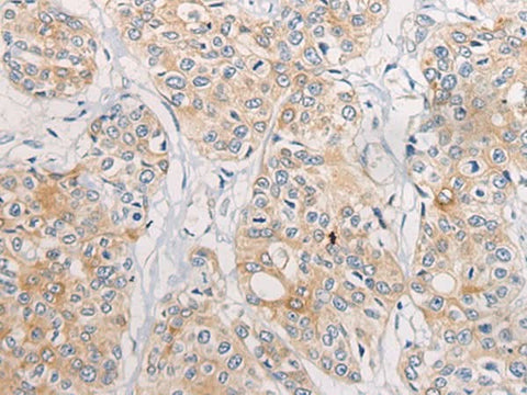 Immunohistochemistry of paraffin-embedded Human prost at e cancer tissue using CPD Polyclonal Antibody at dilution of 1:70(×200)