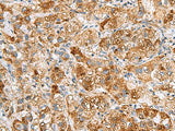 Immunohistochemistry of paraffin-embedded Human liver cancer tissue using NMU Polyclonal Antibody at dilution of 1:80(×200)