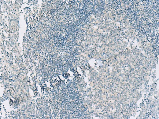 Immunohistochemistry of paraffin-embedded Human tonsil tissue using HASPIN Polyclonal Antibody at dilution of 1:55(×200)