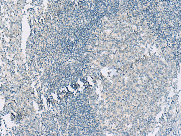 Immunohistochemistry of paraffin-embedded Human tonsil tissue using HASPIN Polyclonal Antibody at dilution of 1:55(×200)