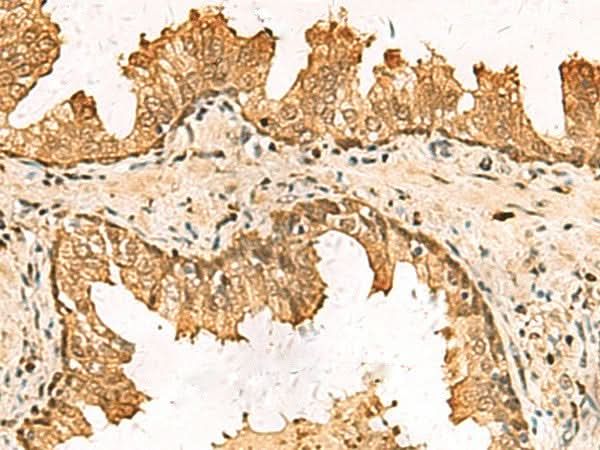 Immunohistochemistry of paraffin-embedded Human prost at e cancer tissue using PDXK Polyclonal Antibody at dilution of 1:75(×200)