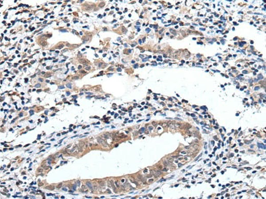 Immunohistochemistry of paraffin-embedded Human cervical cancer tissue using ELMO1 Polyclonal Antibody at dilution of 1:40(×200)