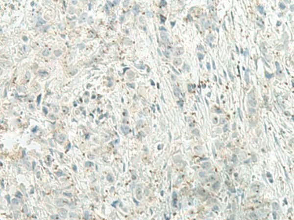 Immunohistochemistry of paraffin-embedded Human breast cancer tissue using UQCC2 Polyclonal Antibody at dilution of 1:60(×200)