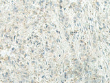 Immunohistochemistry of paraffin-embedded Human breast cancer tissue using UQCC2 Polyclonal Antibody at dilution of 1:60(×200)