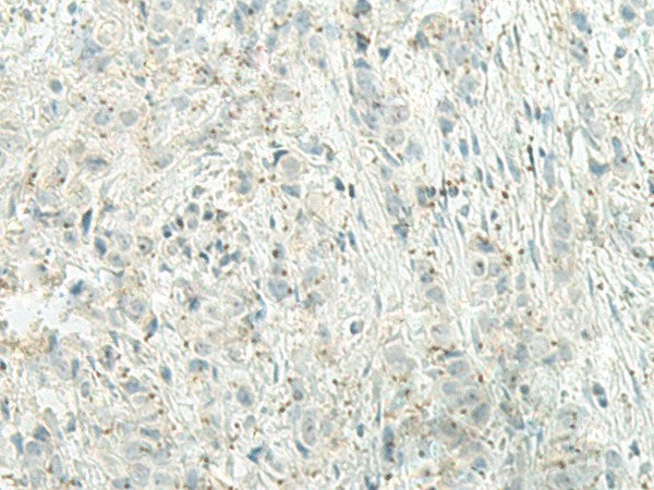 Immunohistochemistry of paraffin-embedded Human breast cancer tissue using UQCC2 Polyclonal Antibody at dilution of 1:60(×200)