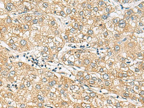 Immunohistochemistry of paraffin-embedded Human liver cancer tissue using DACT3 Polyclonal Antibody at dilution of 1:70(×200)