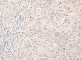 Immunohistochemistry of paraffin-embedded Human cervical cancer tissue using FOXRED2 Polyclonal Antibody at dilution of 1:35(×200)