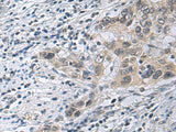Immunohistochemistry of paraffin-embedded Human esophagus cancer tissue using IRS4 Polyclonal Antibody at dilution of 1:45(×200)