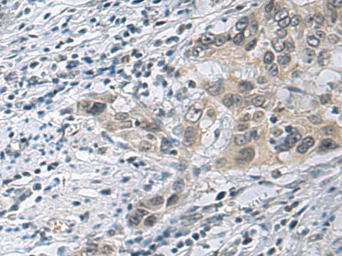 Immunohistochemistry of paraffin-embedded Human esophagus cancer tissue using IRS4 Polyclonal Antibody at dilution of 1:45(×200)