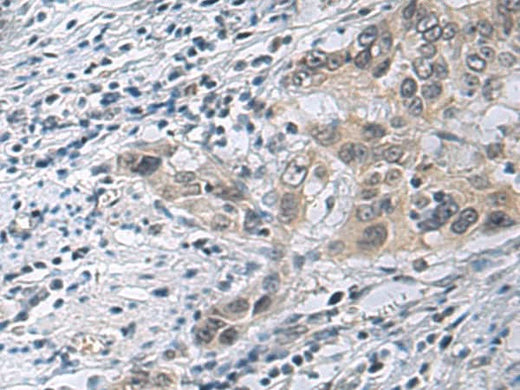 Immunohistochemistry of paraffin-embedded Human esophagus cancer tissue using IRS4 Polyclonal Antibody at dilution of 1:45(×200)