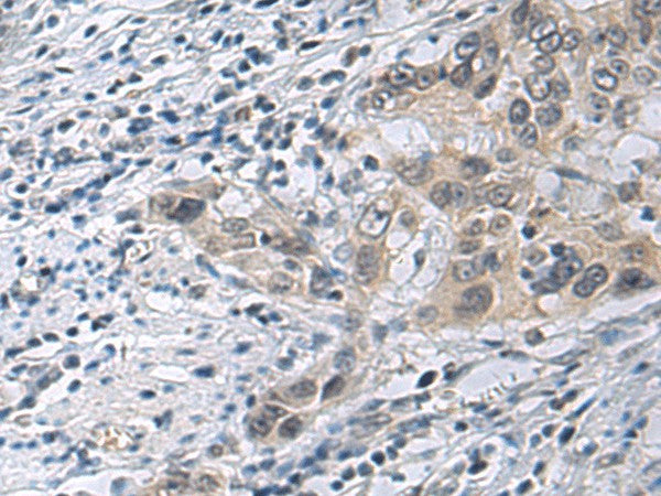 Immunohistochemistry of paraffin-embedded Human esophagus cancer tissue using IRS4 Polyclonal Antibody at dilution of 1:45(×200)