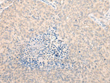 Immunohistochemistry of paraffin-embedded Human cervical cancer tissue using SEPT10 Polyclonal Antibody at dilution of 1:25(×200)