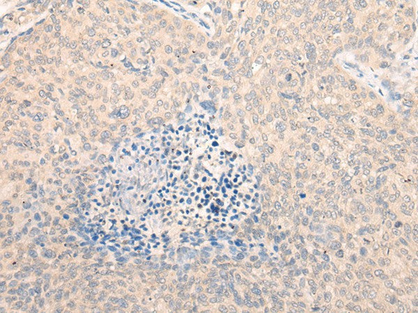 Immunohistochemistry of paraffin-embedded Human cervical cancer tissue using SEPT10 Polyclonal Antibody at dilution of 1:25(×200)