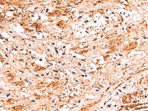 Immunohistochemistry of paraffin-embedded Human liver cancer tissue using NADK Polyclonal Antibody at dilution of 1:70(×200)