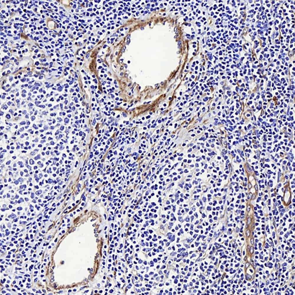 Immunohistochemistry analysis of paraffin-embedded human Lymphoma using LDLR Polyclonal Antibody at dilution of 1:300.