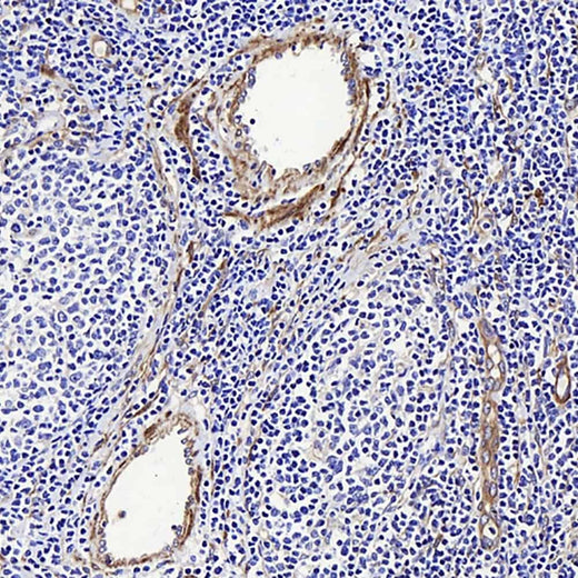 Immunohistochemistry analysis of paraffin-embedded human Lymphoma using LDLR Polyclonal Antibody at dilution of 1:300.