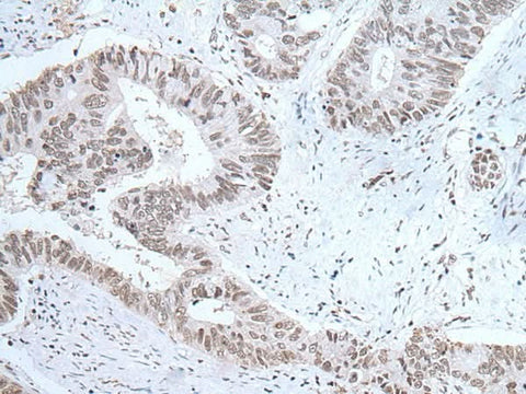 Immunohistochemistry of paraffin-embedded Human colorectal cancer tissue using HCRT Polyclonal Antibody at dilution of 1:25(×200)