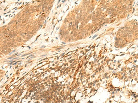 Immunohistochemistry of paraffin-embedded Human esophagus cancer tissue using HES7 Polyclonal Antibody at dilution of 1:25(×200)