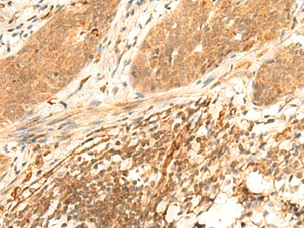 Immunohistochemistry of paraffin-embedded Human esophagus cancer tissue using HES7 Polyclonal Antibody at dilution of 1:25(×200)