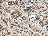 Immunohistochemistry of paraffin-embedded Human breast cancer tissue using DIAPH2 Polyclonal Antibody at dilution of 1:55(×200)