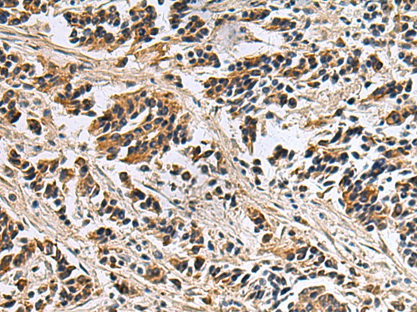 Immunohistochemistry of paraffin-embedded Human breast cancer tissue using DIAPH2 Polyclonal Antibody at dilution of 1:55(×200)