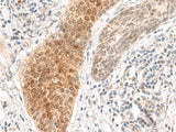 Immunohistochemistry of paraffin-embedded Human esophagus cancer tissue using GHDC Polyclonal Antibody at dilution of 1:90(×200)