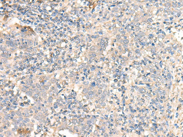 Immunohistochemistry of paraffin-embedded Human cervical cancer tissue using PARS2 Polyclonal Antibody at dilution of 1:30(×200)
