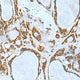 Immunohistochemistry of paraffin-embedded Human thyroid cancer tissue using TSGA10 Polyclonal Antibody at dilution of 1:50(×200)