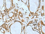 Immunohistochemistry of paraffin-embedded Human thyroid cancer tissue using TSGA10 Polyclonal Antibody at dilution of 1:50(×200)