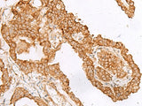 Immunohistochemistry of paraffin-embedded Human thyroid cancer tissue using FAM200A Polyclonal Antibody at dilution of 1:45(×200)