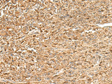 Immunohistochemistry of paraffin-embedded Human liver cancer tissue using ZC3H7A Polyclonal Antibody at dilution of 1:50(×200)