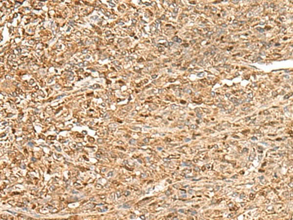 Immunohistochemistry of paraffin-embedded Human liver cancer tissue using ZC3H7A Polyclonal Antibody at dilution of 1:50(×200)