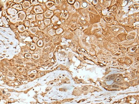 Immunohistochemistry of paraffin-embedded Human esophagus cancer tissue using IL6ST Polyclonal Antibody at dilution of 1:40(×200)
