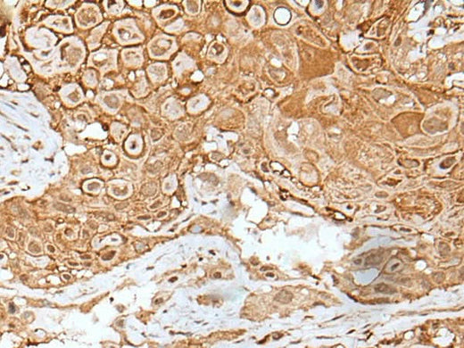 Immunohistochemistry of paraffin-embedded Human esophagus cancer tissue using IL6ST Polyclonal Antibody at dilution of 1:40(×200)
