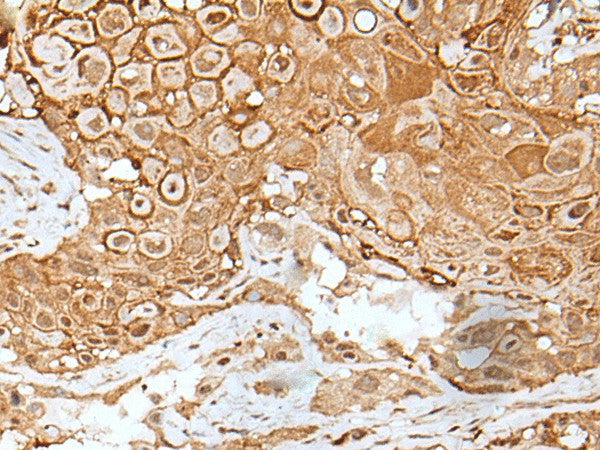 Immunohistochemistry of paraffin-embedded Human esophagus cancer tissue using IL6ST Polyclonal Antibody at dilution of 1:40(×200)