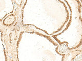 Immunohistochemistry of paraffin-embedded Human thyroid cancer tissue using ZFYVE27 Polyclonal Antibody at dilution of 1:50(×200)