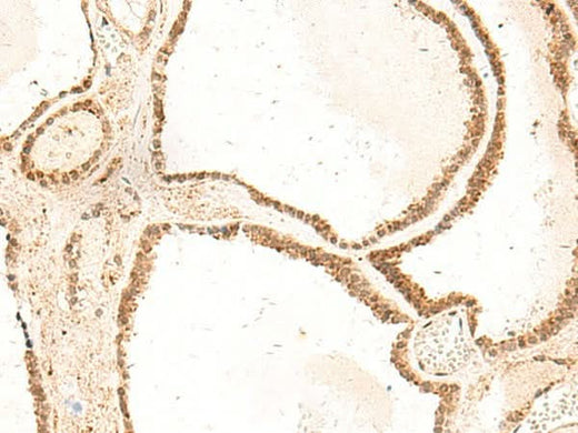 Immunohistochemistry of paraffin-embedded Human thyroid cancer tissue using ZFYVE27 Polyclonal Antibody at dilution of 1:50(×200)