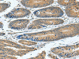 Immunohistochemistry of paraffin-embedded Human colorectal cancer tissue using CLEC1B Polyclonal Antibody at dilution of 1:55(×200)