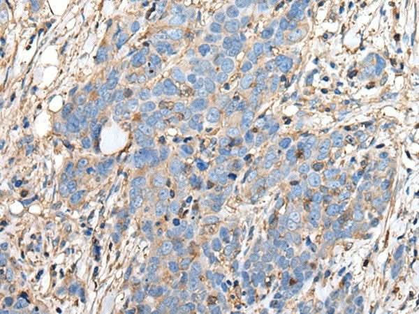 Immunohistochemistry of paraffin-embedded Human thyroid cancer tissue using PLA2G16 Polyclonal Antibody at dilution of 1:40(×200)