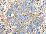 Immunohistochemistry of paraffin-embedded Human thyroid cancer tissue using PLA2G16 Polyclonal Antibody at dilution of 1:40(×200)