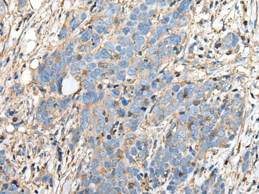 Immunohistochemistry of paraffin-embedded Human thyroid cancer tissue using PLA2G16 Polyclonal Antibody at dilution of 1:40(×200)