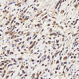 Immunohistochemistry analysis of paraffin-embedded human stomach cancer using CDK4 Polyclonal Antibody at dilution of 1:100.