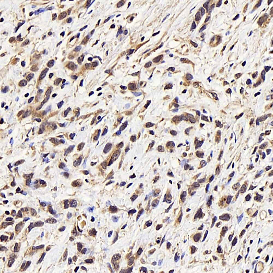 Immunohistochemistry analysis of paraffin-embedded human stomach cancer using CDK4 Polyclonal Antibody at dilution of 1:100.